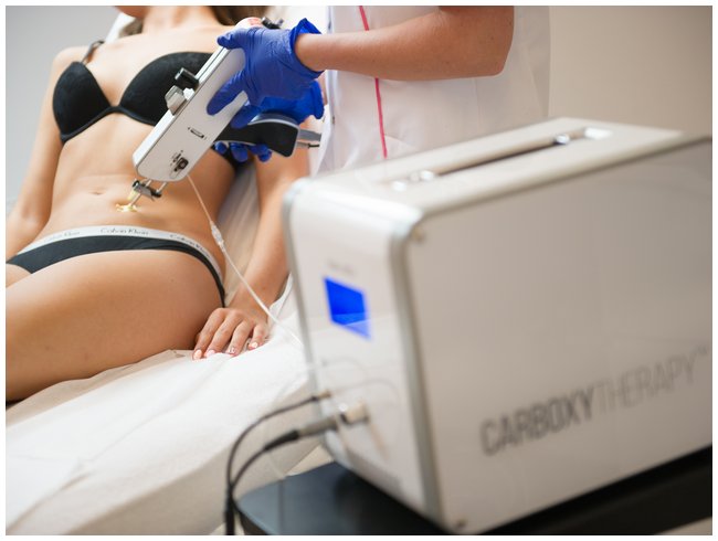 Karboksyterapia