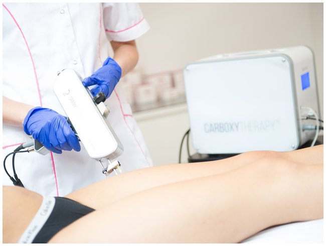 Karboksyterapia